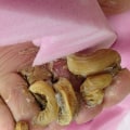 Ram's Horn Toenail Treatment Options You Should Know
