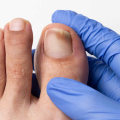 Stop Toenail Fungus Early: Stages and Pictures to Watch