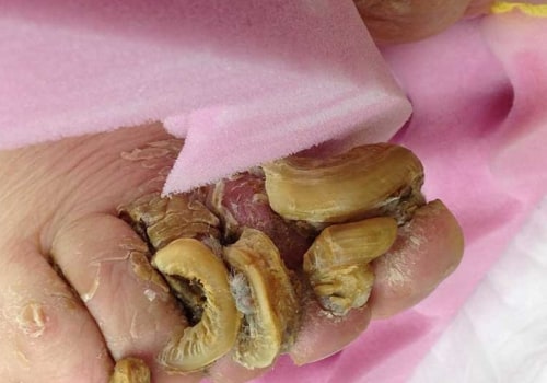 Ram's Horn Toenail Treatment Options You Should Know