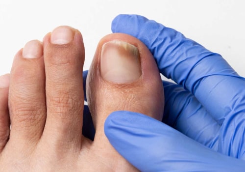 Stop Toenail Fungus Early: Stages and Pictures to Watch